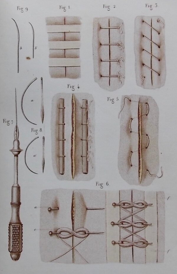 BERNARD (Claude) & HUETTE (Ch.) Précis iconographique de médecine opératoire et d'anatomie chirurgicale. Paris, Méquignon-Marvis, 1854. – Image 6