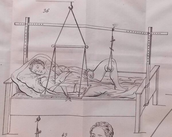 MAYOR (Matthias) Nouveau système de déligation chirurgicale, ou Exposé de moyens simples et faciles de remplacer avec avantage les bandes et la charpie; de traiter les fractures sans attelles et sans obliger les blessés de garder le lit; de redresser les gibbosités sans lits mécaniques; de soulever les malades sans douleurs ni embarras; de mettre le traitement d'un grand nombre d'affections chirurgicales graves à la portée des masses, en l'absence des hommes de l'art, et de populariser la chirurgie dans les armées. [suivi de] Fragmens de chirurgie populaire. Paris, Genève & Lausanne, Cherbulier & Doy, 1832-1831. – Image 5